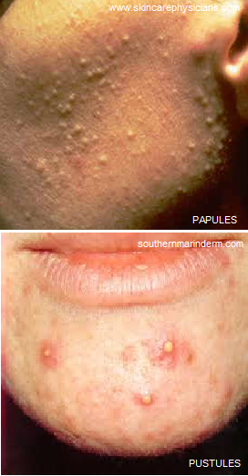 pimples 2 10.13.14